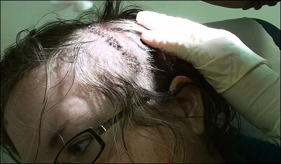 ظلت في كامل وعيها ومازحت الأطباء خلال عملية جراحية في دماغها!