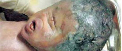 في حالة نادرة: عراقية تلد طفلا بعين واحدة وبدون انف!!