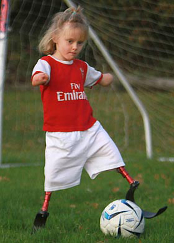 طفلة مبتورة الارجل والايدي تنضم لفريق كرة القدم بمدرستها!! طفلة مبتورة الارجل والايدي تنضم لفريق كرة القدم بمدرستها!!