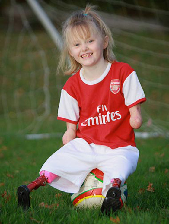 طفلة مبتورة الارجل والايدي تنضم لفريق كرة القدم بمدرستها!! طفلة مبتورة الارجل والايدي تنضم لفريق كرة القدم بمدرستها!!