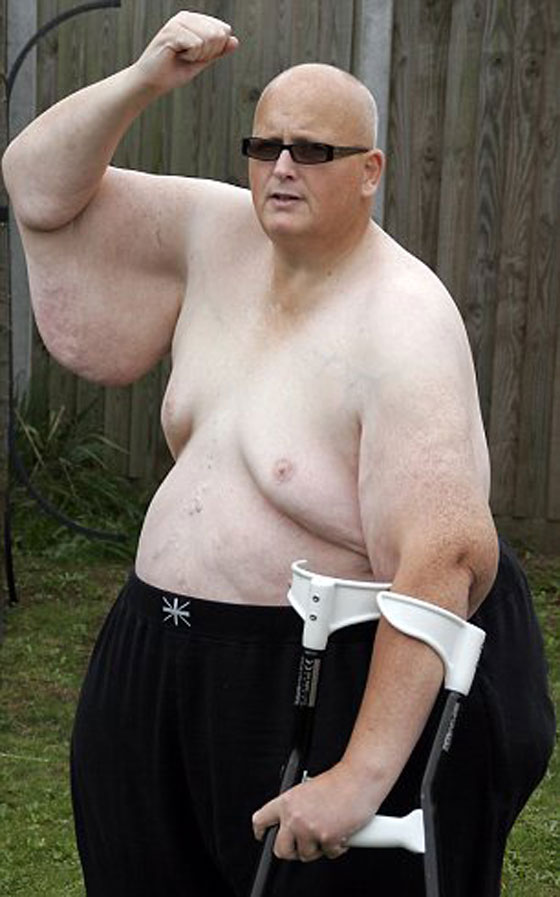 اثقل رجل بالعالم يقوم بانقاص اكثر من نصف وزنه! 