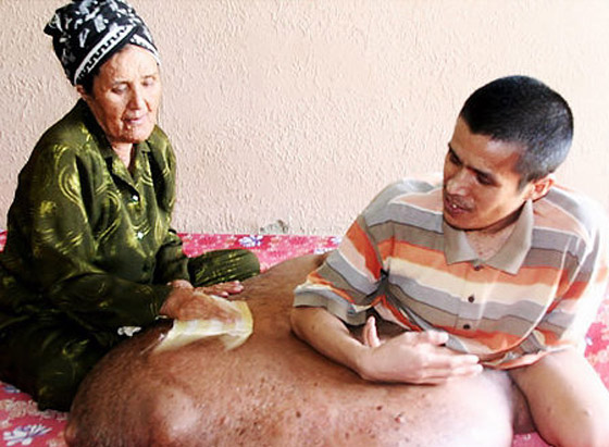 بعد ان خرج نموه عن السيطرة.. استئصال ورم هائل من ساق رجل! بعد ان خرج نموه عن السيطرة.. استئصال ورم هائل من ساق رجل!