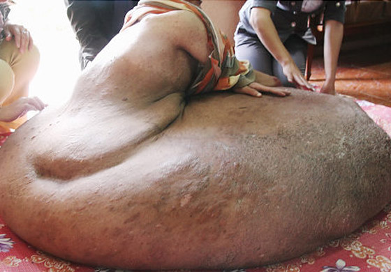 بعد ان خرج نموه عن السيطرة.. استئصال ورم هائل من ساق رجل! بعد ان خرج نموه عن السيطرة.. استئصال ورم هائل من ساق رجل!