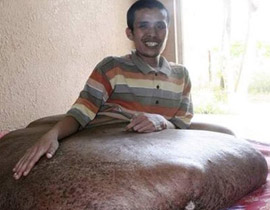 فيتنامي يعاني من اكبر ورم في العالم وزنه 80 كجم